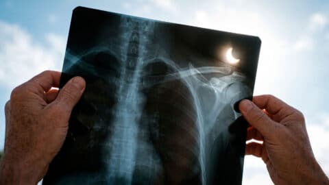 Manos sosteniendo una radiografía médica frente al cielo para observar un eclipse solar parcial.